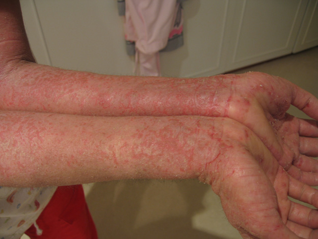 eczema